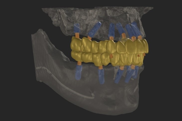 Digital dental planning