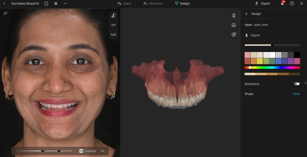 Digital smile design