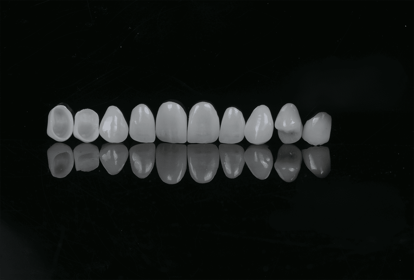Dental Veneers