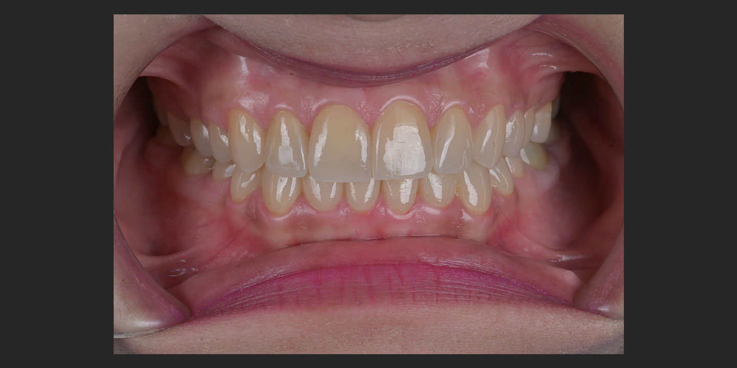 Full-Mouth Rehabilitation