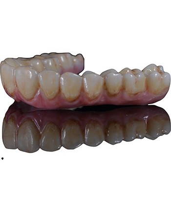 Full Mouth Dental Implants