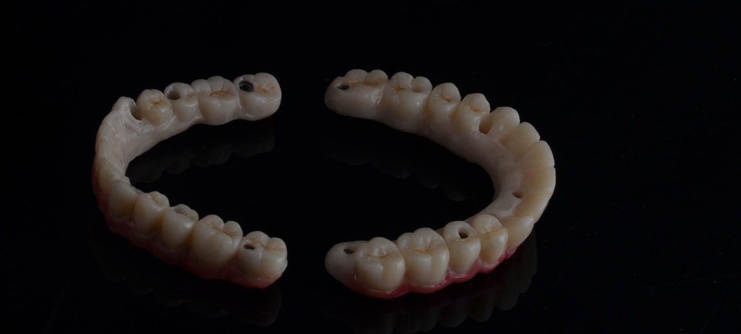 Full Mouth Dental Implants