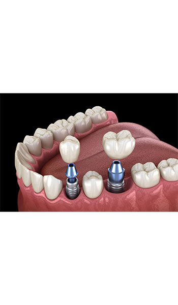 Multiple Teeth Implants