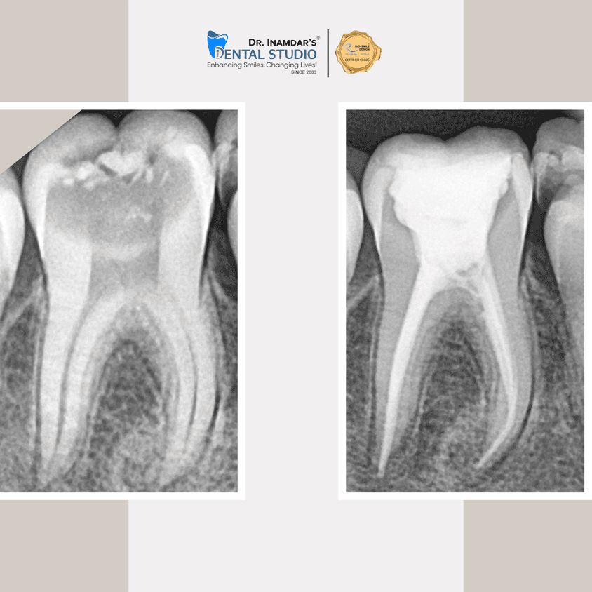 Root Canal Treatment