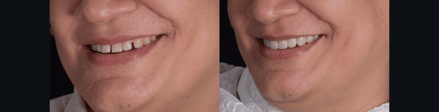 Smile Makeover