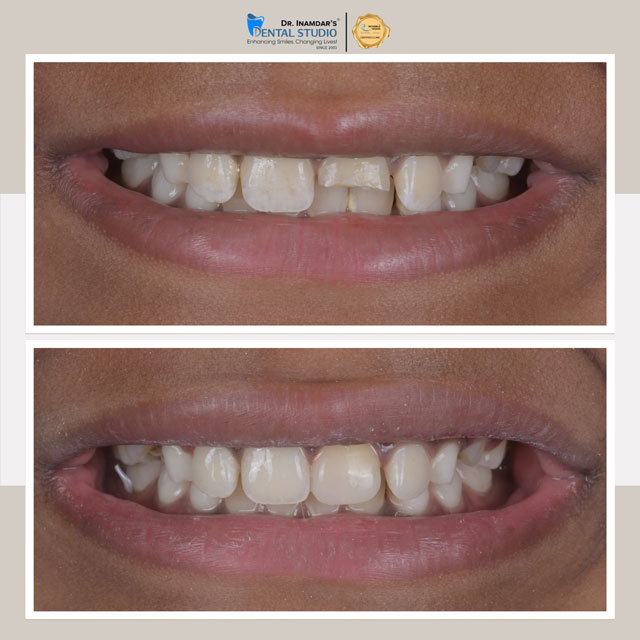 Tooth Colored Fillings