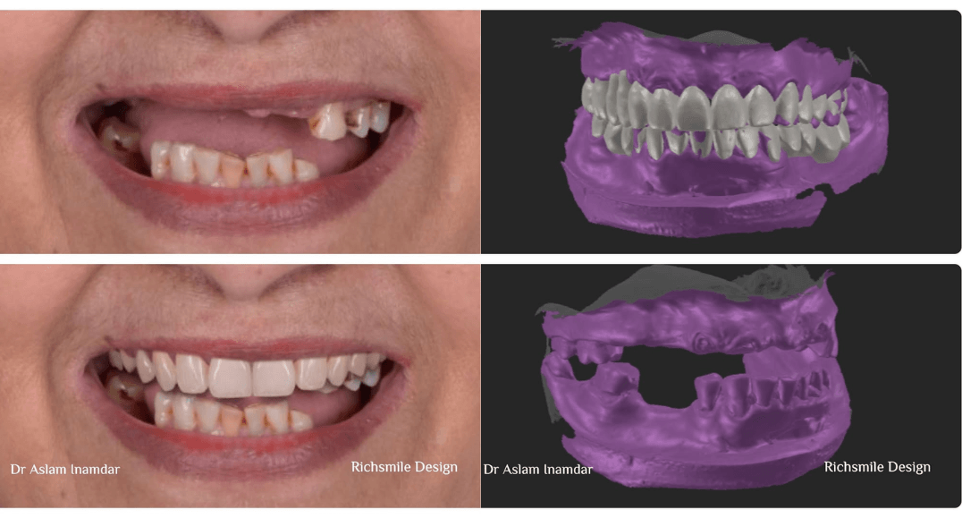 What Planning Is Required for 1–2 Day Full Mouth Dental Treatment
