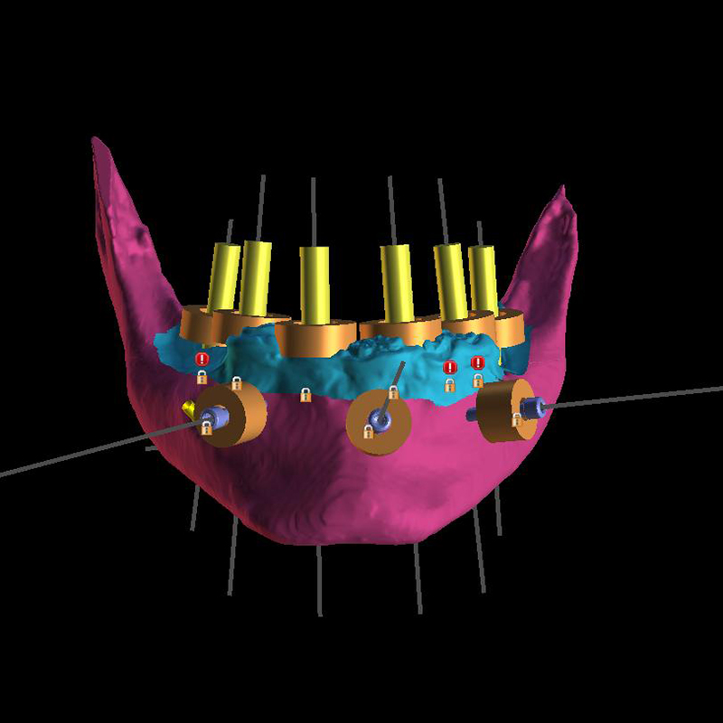 Meet the New-Age Dental Implants!