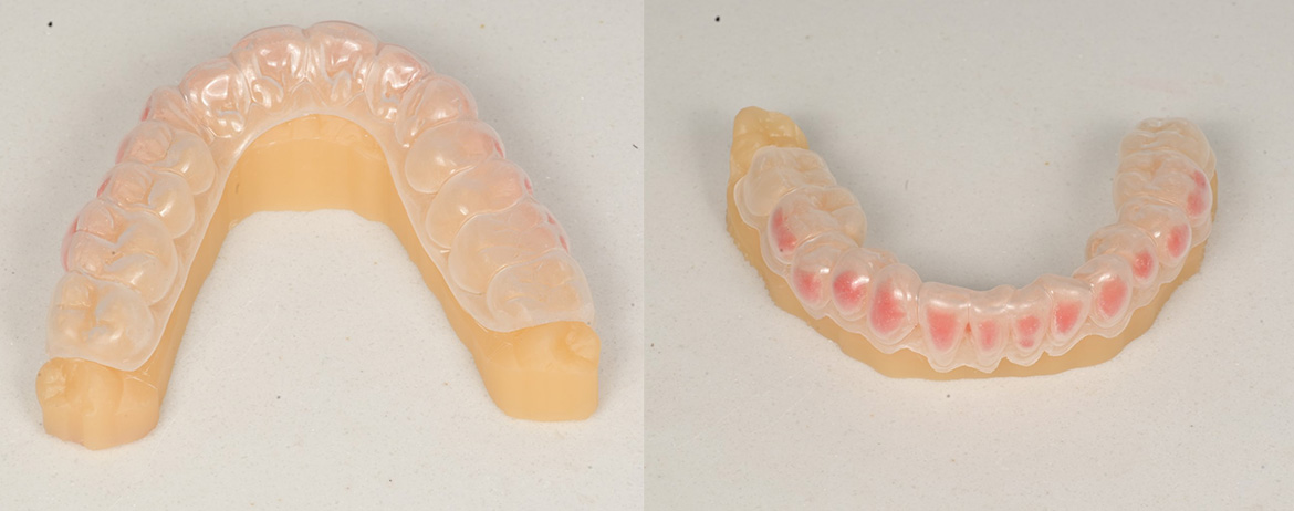 At-home Whitening Kit