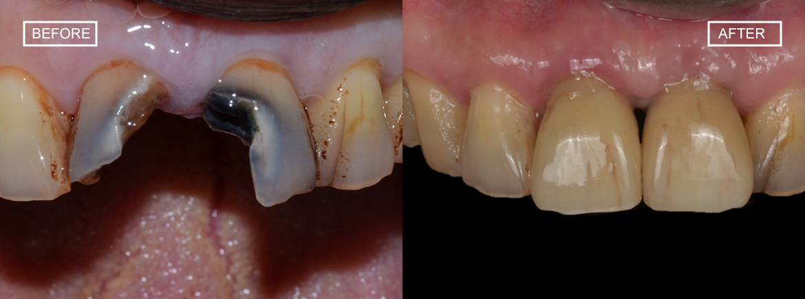 Before after dental implant case pictures together