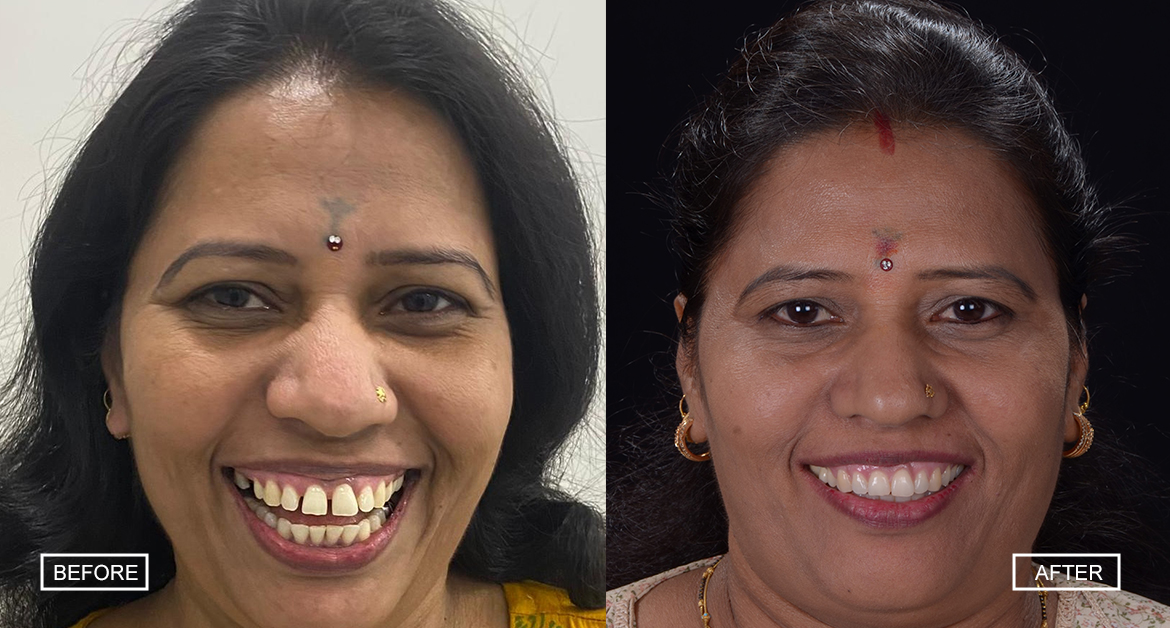 Before after case of braces together