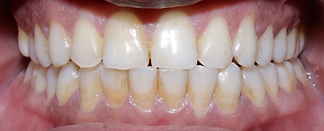 Before teeth whitening case