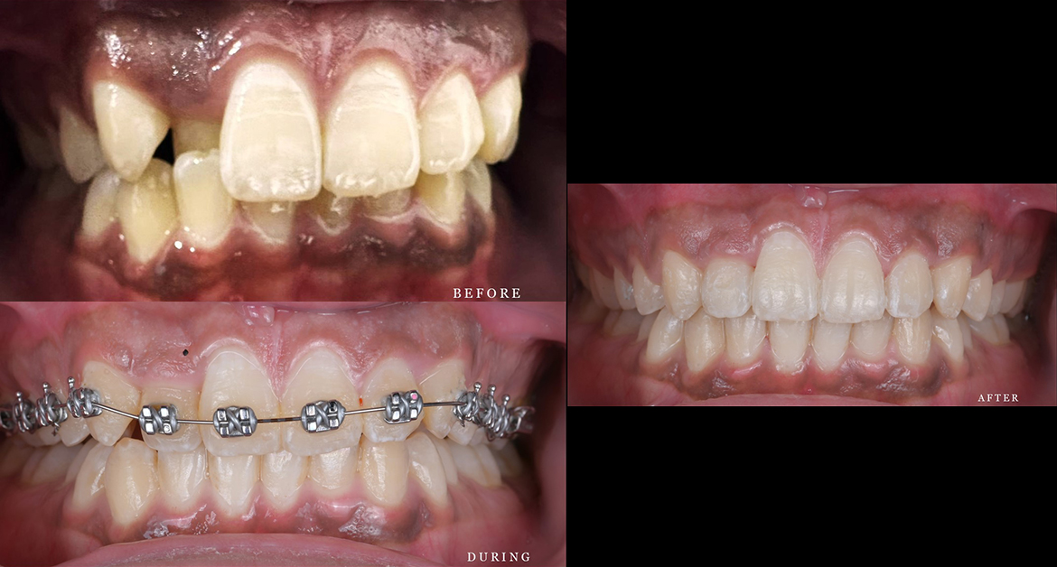 Before, during and after case of braces