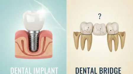 Dental Bridges vs. Implants: Which One Lasts Longer
