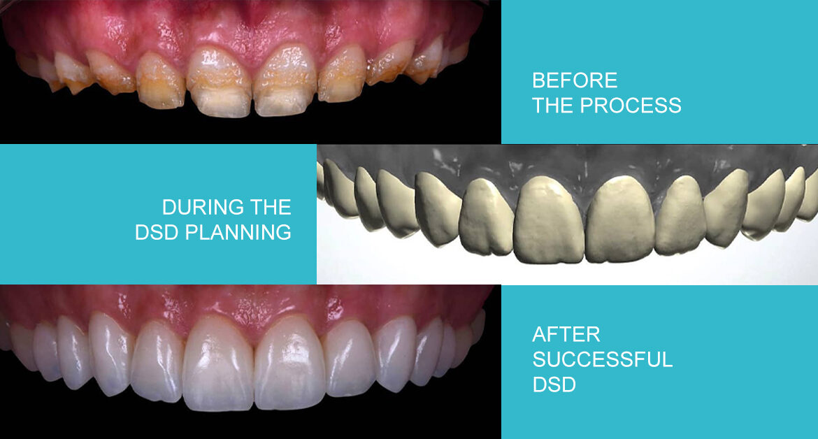 Transform Your Smile with Digital Smile Design
