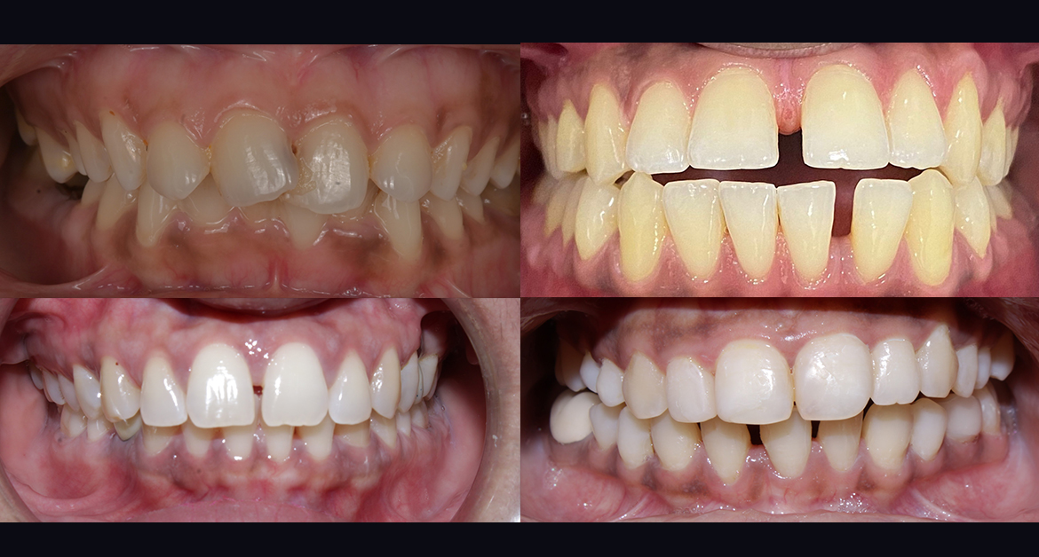 Crowding, spacing, and minor bite problems in teeth