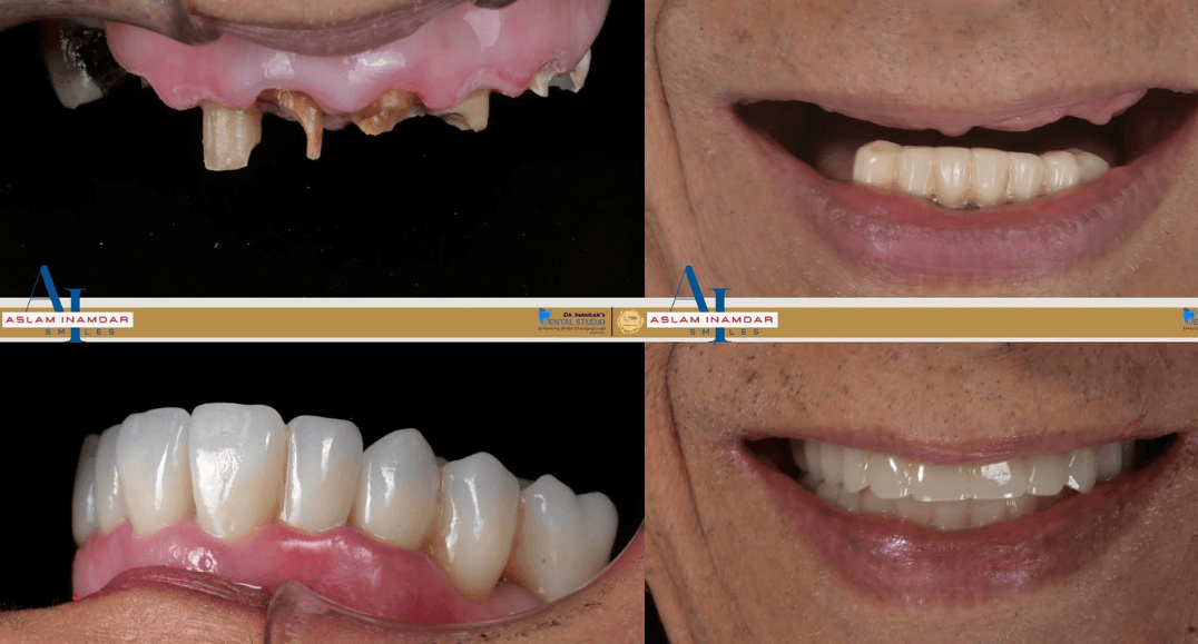 Full Mouth Dental Solutions After Years of Neglect or Failed Dental Work