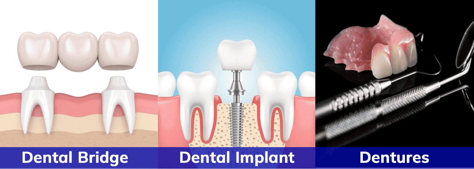 Dental implants, bridges, and dentures displayed together