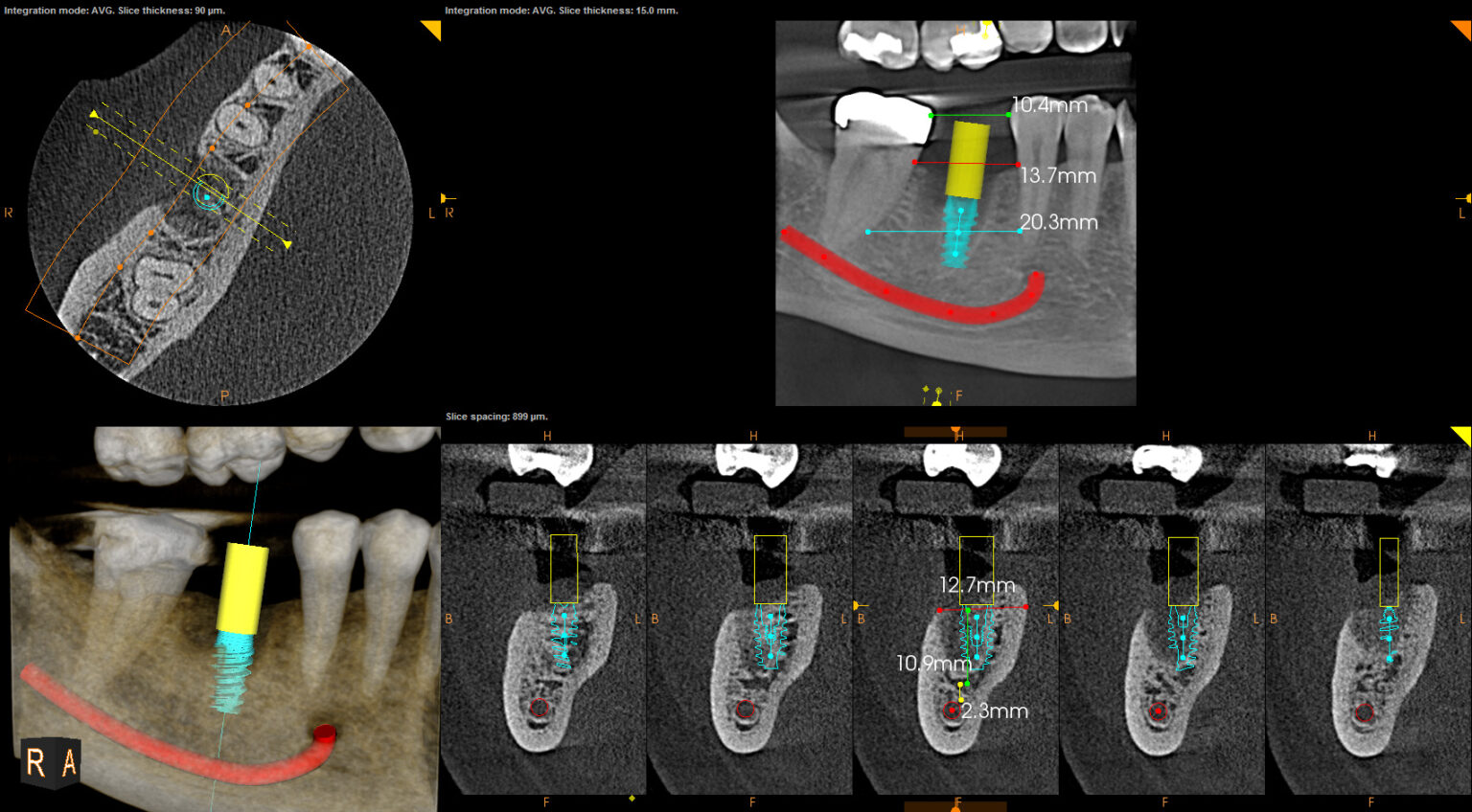 CBCT Scan of teeth