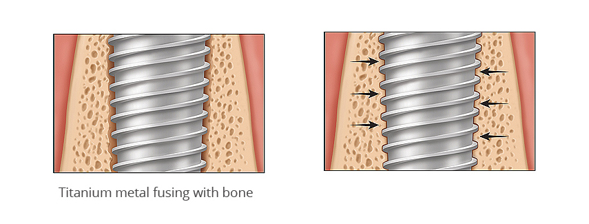 Titanium metal fusing with bone