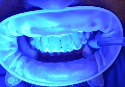 Applied a whitening gel to teeth and activated it with a blue light