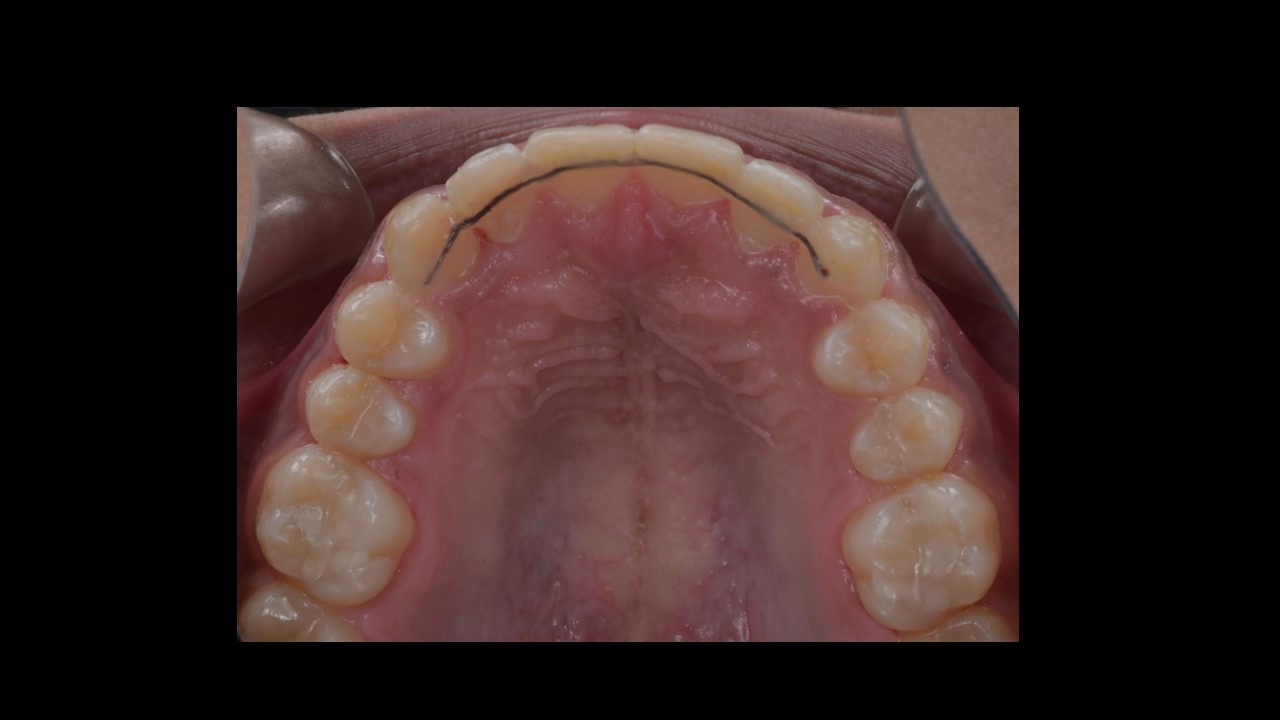 Close-up of a person's mouth