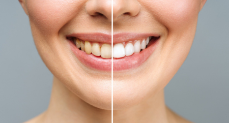 The Truth About DIY Teeth Whitening — What’s Safe & What’s Not