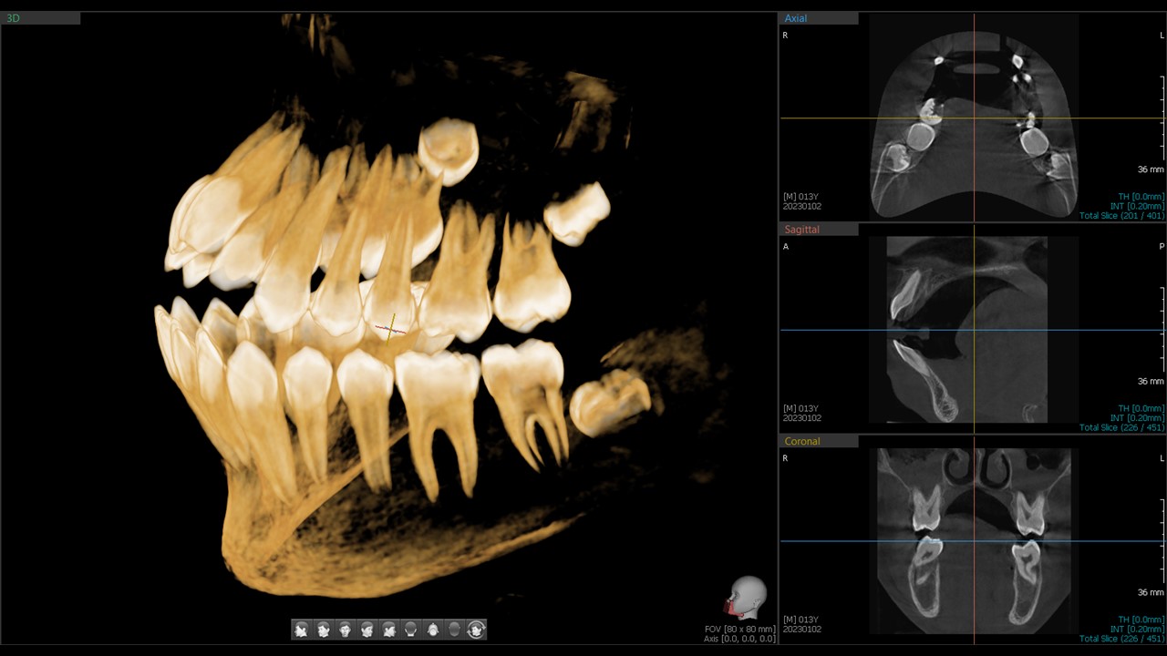 Advanced 3D planning of teeth
