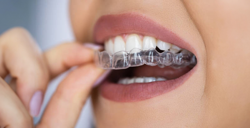 Woman wearing clear aligner