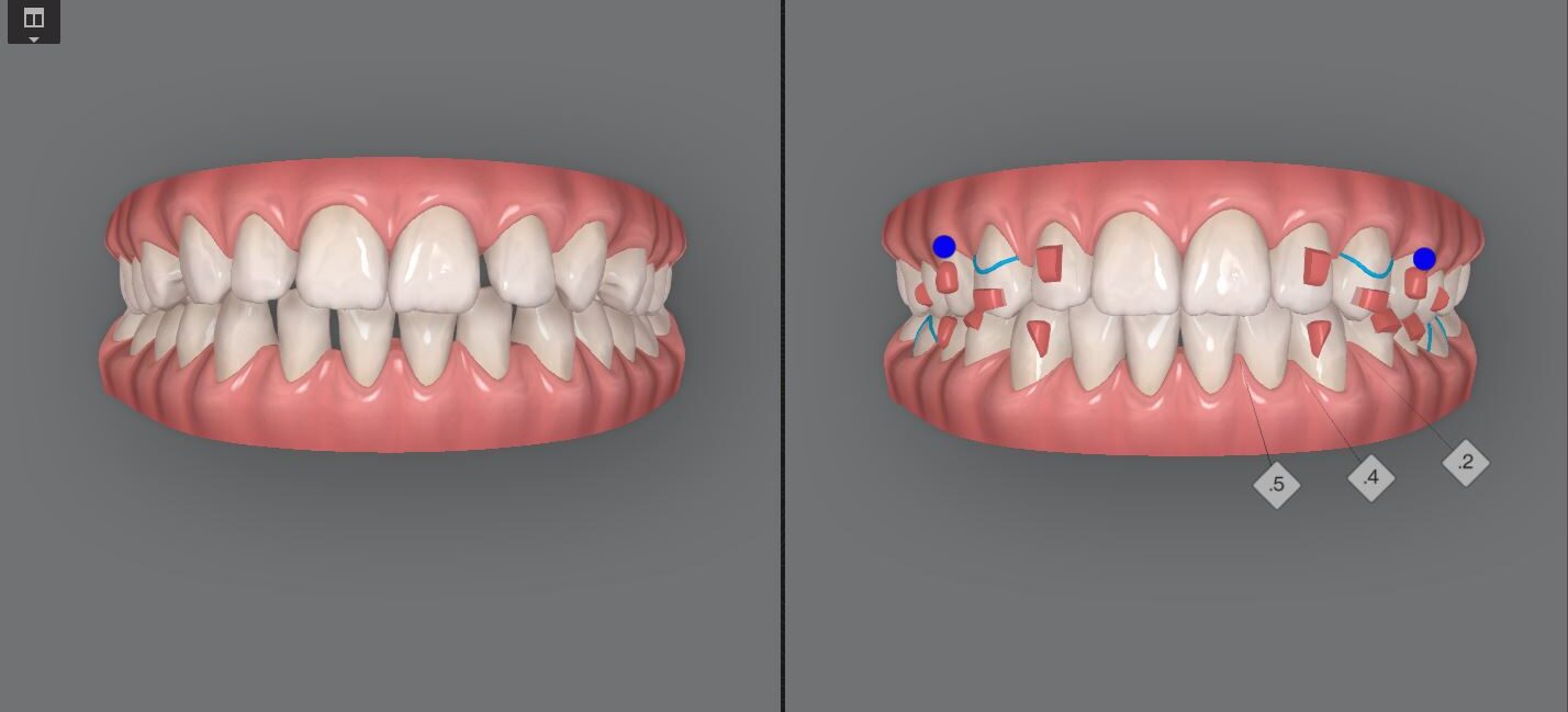 3D model of before after clear aligner