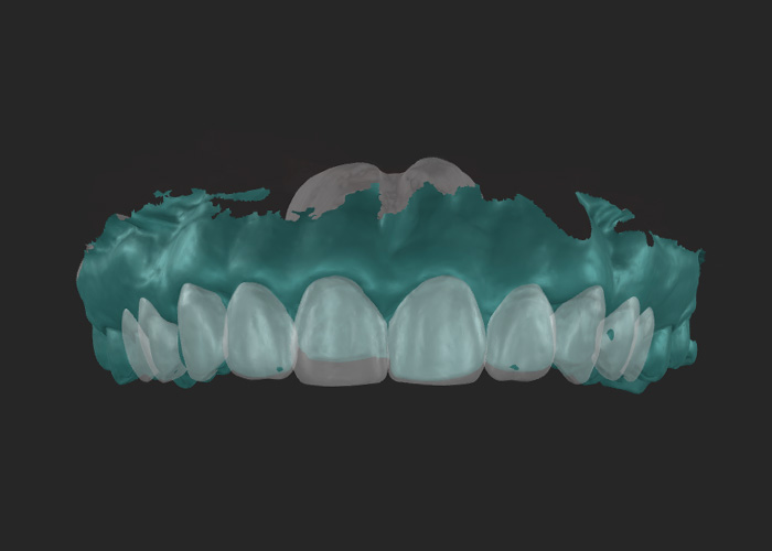 Dental intraoral scan