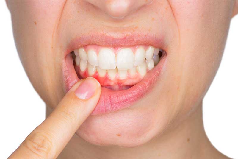 signs of gum disease strip2