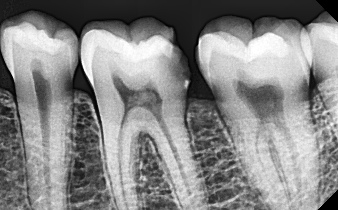 What to Expect During a Root Canal at Dr. Inamdars Dental Studio