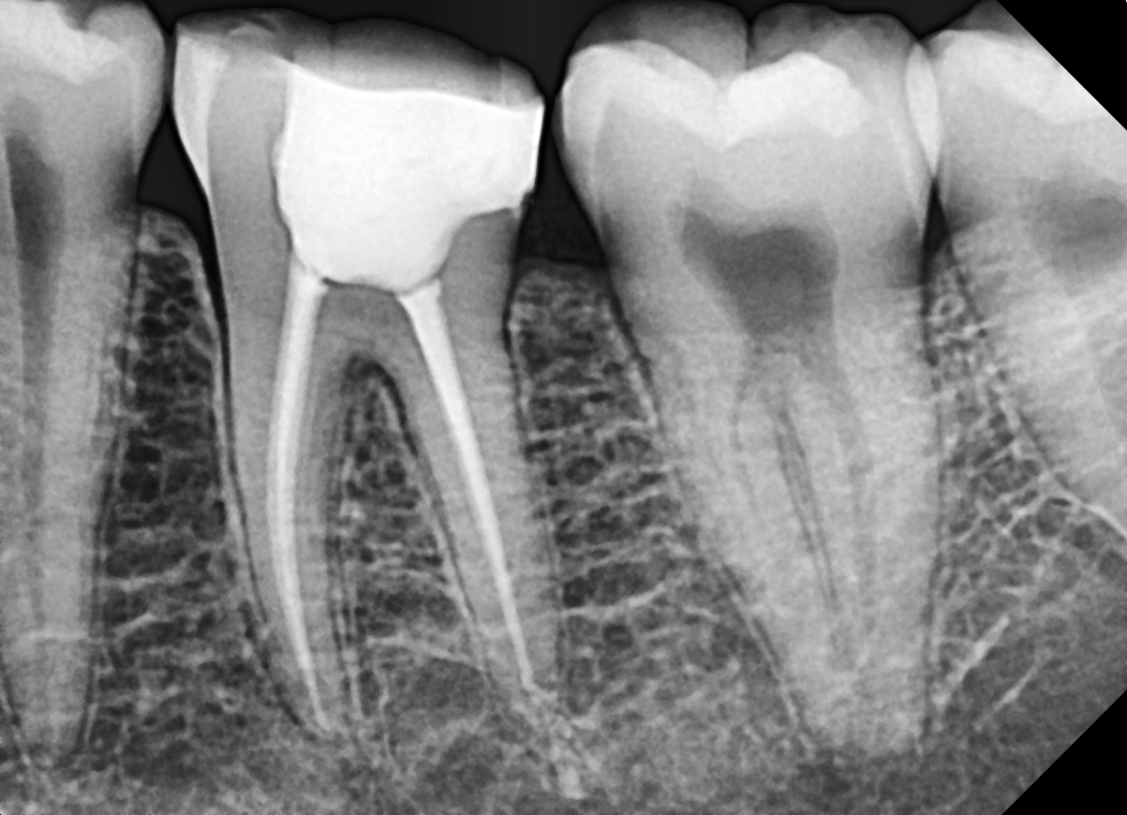 What to Expect During a Root Canal at Dr. Inamdars Dental Studio1